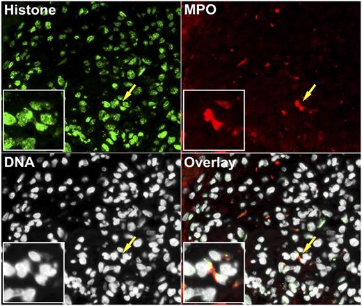 FIGURE 5. Netting neutrophils are present in glomeruli from patients with lupus nephritis. Colocalization of histone H2A (green), MPO (red), and DNA (white) by direct immunofluorescence reveals in vivo evidence of NET formation in a glomerulus from a representative kidney microphotograph from a patient with class IV lupus nephritis. Yellow arrows and inset boxes highlight intraglomerular NET formation. Original magnification ×20.