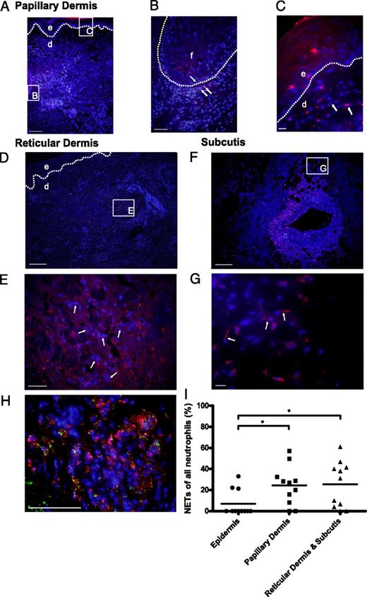 FIGURE 6. Netting neutrophils are present in affected lupus dermis and subcutis. Direct immunofluorescence staining of DNA (blue) and MPO (red) reveal NETs throughout affected lupus skin. A, Low-power view of a punch biopsy from lesional lupus skin. Scale bar, 200 μm. B, Arrows highlight perifollicular infiltration of NETs. Scale bar, 50 μm. C, NETs within the papillary dermis. Scale bar, 20 μm. Low-power view of lupus reticular dermis (D; scale bar, 200 μm) with arrows highlighting infiltration by NETs (E; scale bar, 50 μm). Low-power view of a large blood vessel in affected lupus subcutis (F; scale bar, 200 μm), with arrows highlighting NETs in an area of panniculitis (G; scale bar, 20 μm). Dotted line delineates the dermal-epidermal junction (in A, C, D) and circumscribes the follicle (“f”) in B. Epidermis is designated “e” and dermis by “d”. H, Cathelicidin (LL-37) is present in NETs within inflamed lupus skin lesions. Expression of LL-37 in neutrophils in lupus tissue was examined by dual-color immunofluorescence staining for LL-37 (green) and MPO (red) with DAPI counterstain (blue). Representative images from one of three sections stained with LL-37 and MPO (original magnification ×600). Scale bar, 100 μm. I, Frequency of NETosis in cutaneous lupus lesions. NETs and neutrophils were counted after immunofluorescence staining with MPO and DAPI. Percentage of neutrophils undergoing NETosis of all neutrophils was calculated for the epidermis, papillary dermis, reticular dermis, and subcutis. *p < 0.05.