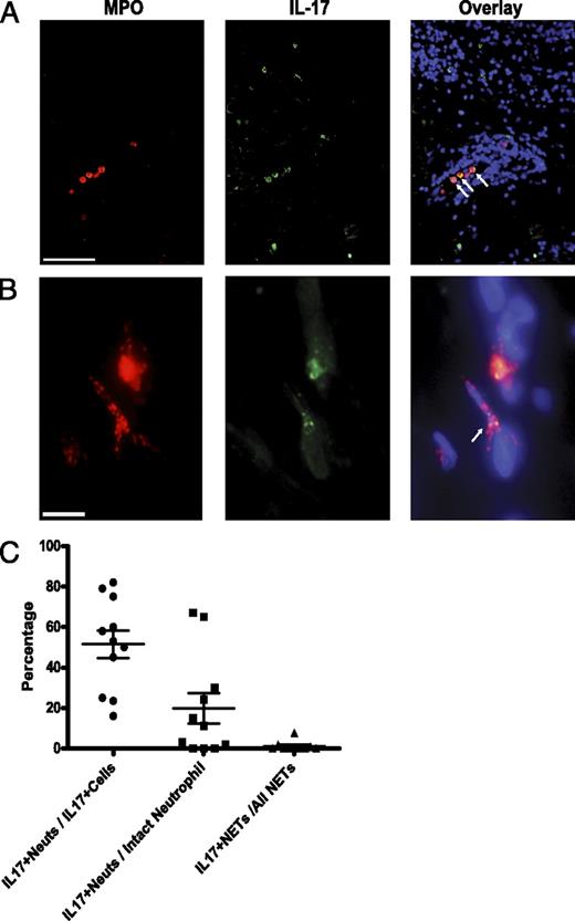 FIGURE 7. IL-17–positive neutrophils infiltrate SLE skin. Direct immunofluorescence staining of IL-17 (green) and MPO (red) in affected lupus dermis. A, Arrows highlight intact IL-17+ neutrophils in a blood vessel. Scale bar, 200 μm. B, IL-17 present in a NET (arrow). Scale bar, 10 μm. C, Frequency of IL-17 expression in intact neutrophils and NETs in SLE skin. Percentages of: 1) IL-17+ neutrophils of all IL-17+ cells (●); 2) IL-17+ neutrophils of all intact neutrophils (■); and 3) IL-17+ NETs of all NETs (▴) are reported in the graph.