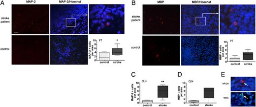 FIGURE 2. Cells immunoreactive to brain Ags are found in human lymphoid tissue samples and are more abundant in stroke patients than in controls. Biopsy specimens PTs (n = 6 stroke; n = 7 controls; A–C) and necropsy specimens of CLNs (n = 5 stroke; n = 5 controls; D, E) were used for immunofluorescence staining (red) against MAP2 (A, D) or MBP (B, C, E). MAP2 (A) and MBP (B) immunoreactive cells were observed both in patients and in controls. Patients had a greater number of MAP2+ cells (A) and a trend to greater number of MBP+ cells (B) than controls in PTs and in CLNs (C, D). (E) Cells immunoreactive to the NMDA receptor NR-2A (red) and to MOG (green) in the PTs of stroke patients. Nuclei are stained in blue with Hoechst. Scale bar, 50 μm (A, B); magnified insets in (A) and (B) and images in (E), 15 μm. *p = 0.05, **p < 0.05.