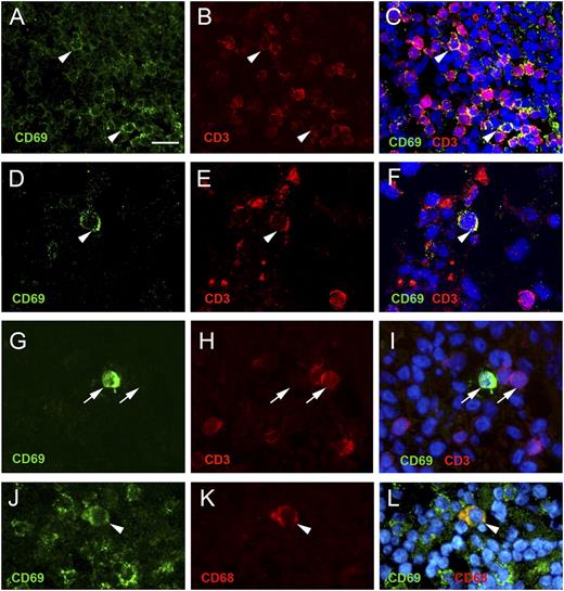 FIGURE 9. CD69+ cells in stroke cases are mainly T cells. The majority of CD69+ cells (green) are T cells (CD3+, red; A–F) that appear in bundles (A–C), but isolated CD69+ cells negative for CD3 are sporadically seen (G–I). (J–L) Double immunohistochemistry for CD69 (green) and CD68 (red) shows one CD68+ macrophage that is immunoreactive to CD69 (arrowhead). Arrowheads indicate CD69+ cells double stained with either CD3 (A–F) or CD68 (J–L). Arrows (G–I) indicate the same location in the tissue for the different immunofluorescence channels and evidence cells reactive to either CD69 (green) or CD3 (red). Nuclei are stained in blue with Hoechst in (C), (F), (I), and (L). Images in (D)–(F) were taken at the confocal microscope. Samples are from PTs (A–I) and CLNs (J–L) of stroke patients. Scale bars, 20 μm (A–C), 15 μm (D–L).