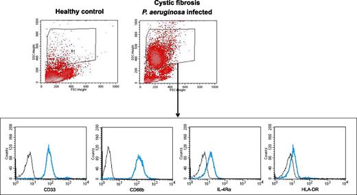 FIGURE 1. Characterization of human MDSCs. MDSCs were characterized in the forward scatter (FSC)/side scatter (SSC) area as a granulocytic cell population in the PBMC fraction (low-density neutrophils) (R1), as published previously (13, 15). This population was distinct from lymphocytes, monocytes, erythrocytes, or debris. Within R1, neutrophilic MDSCs were identified as a CD33highCD66bhighIL-4RαinterHLA-DRdim–expressing neutrophilic MDSC population. MDSCs are shown in a representative healthy control subject and a CF patient infected with P. aeruginosa.