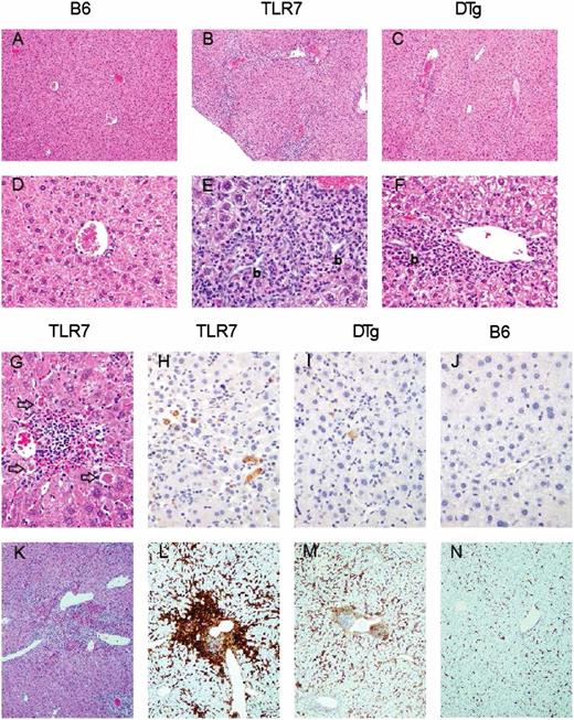 FIGURE 5. DTg mice have a marked reduction in hepatic inflammation and necrosis relative to TLR7 Tg mice. Representative liver sections from control (B6), TLR7.1, and DTg mice. Sections of WT liver [(A), ×10; (D), ×40) showing normal hepatic structure. A normal portal triad is centrally placed in plate D. Liver from TLR7 Tg mice demonstrates bridging between triads by highly cellular inflammatory and stromal elements [(B), ×10]. At ×40 (E), portal triads are fully surrounded by tissue macrophages (some of which contain brown hemosiderin pigment) admixed with lymphocytes, neutrophils, and fibrous tissue elements. Bile duct hyperplasia (b), limiting plate necrosis, and apoptosis of individual hepatocytes occur in severely affected triads (E). DTg mice have a similar type of inflammatory hepatitis, although much less severe and rarely bridges adjacent triads [(C), ×10; (F), ×40]. Similarly, bile duct hyperplasia (b), limiting plate necrosis, and apoptosis are less common and milder in degree. The lower severity of hepatic inflammation in DTg mice is reflected by a lower lesion severity score of 2.1 ± 1.1 (compared with 4.3 ± 0.8 for TLR7 Tg, n = 6/group; p = 0.006) and fewer inflammatory cell foci (8.2 ± 5.8 per random ×10 field compared with 32.6 ± 5.8 for TLR7 Tg mice; p = 0.001). See Materials and Methods for definitions and Supplemental Table I for analysis of individual mice. Classical shrunken apoptotic hepatocytes (arrows) are common typically near margins of inflammatory foci [(G), ×40] and revealed by staining with Ab to activated caspase-3 [light brown in (H)–(J), ×40]. F4/80 staining of the inflammatory foci in TLR7.1 mice [(B), ×10; (E), ×40; (K), ×10] revealed intense staining surrounding triads and central veins [dark brown, (L), ×10].