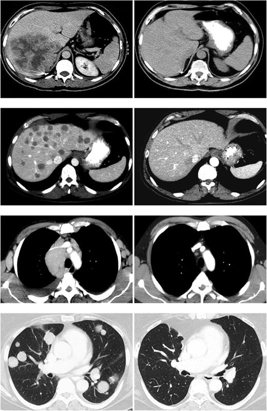 FIGURE 1. Upper panel, Fifty-six–year-old male with metastatic renal cell cancer to the liver and subcarinal lymph nodes was treated with high-dose bolus IL-2 in January 1994. Patient underwent a complete regression of all disease and remains disease-free 20 y later. Upper middle panel, Fifty-four–year-old male with metastatic melanoma to the lungs and liver was treated with autologous TILs plus IL-2 following a lymphodepleting regimen in December 2003. The patient underwent a complete regression of all disease and remains disease-free >10 y later. Lower middle panel, Fifty-year-old male with follicular non-Hodgkin’s lymphoma at multiple sites in the abdomen, mediastinum, and axillary lymph nodes treated with genetically engineered autologous peripheral lymphocytes expressing a gene encoding an anti-CD19 chimeric Ag receptor in May 2009. The patient underwent a dramatic regression of all disease following two cycles of treatment and is progression-free >4 y later. Lower panel, Sixty-seven–year-old female with metastatic synovial sarcoma to the lung and right pelvis treated with genetically engineered autologous peripheral lymphocytes expressing a gene encoding a TCR reactive with the NY-ESO-1 cancer testes Ag in August 2010. The patient was treated in August 2010 and has undergone a dramatic partial regression now ongoing >3 y later.