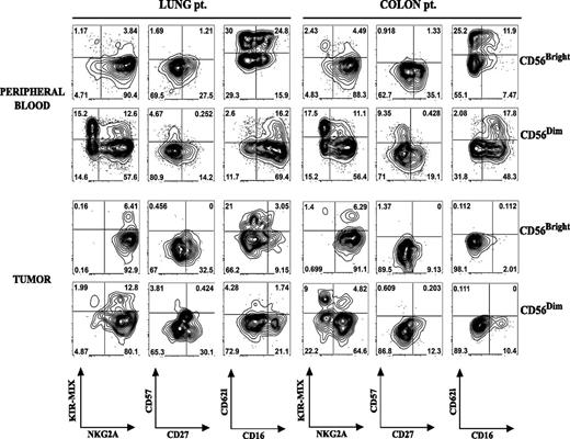 FIGURE 6. Comparative phenotype between tumor-infiltrating and autologous PB NK cells. Lung and colon carcinomas were processed as described in Materials and Methods and tissue-resident NK cells stained with mAbs specific for the indicated markers and analyzed by flow cytometry. Analyses were performed in both CD56brightperforinlow (CD56Bright) and CD56dimperforinhigh (CD56Dim) NK cells. As a comparison, NK isolated from PB of the same patients were also analyzed. Data shown are representative of analyses performed in six different patients (three NSCL cancer and three colon carcinomas) with similar results.