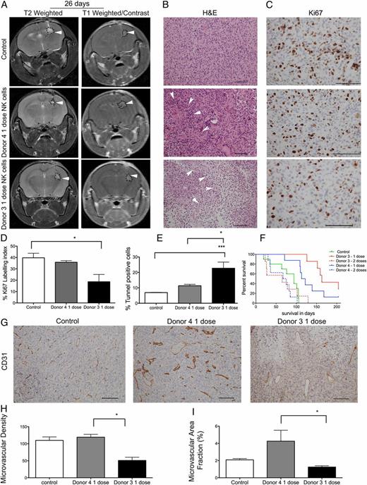 FIGURE 3. Treatment with a single dose of NK cells significantly increases animal survival. (A) T2-weighted and postcontrast T1-weighted images of NOD/SCID mice bearing P3 tumors treated with one dose of NK cells from donor 4 or donor 3 or controls. Tumors are indicated by arrowheads. (B) H&E staining of tumors treated with donor 3–derived or donor 4–derived NK cells. Necrosis is indicated by arrowheads (scale bar, 100 μm; original magnification ×200). (C) Ki-67+ cells (scale bar, 100 μm; original magnification ×400). Percentage Ki-67–positive (D) and cell death as represented by the percentage of TUNEL+ apoptotic/necrotic cells (E). Data are mean ± SEM. (F) Kaplan–Meier survival curves of animals treated with vehicle PBS/CD2 and NKp46 Abs (n = 10 animals) or with one or two doses of NK cells from donor 4 or donor 3 (n = 7 animals/group). (G) CD31 immunostaining from control mouse and mice that received one dose of NK cells from donor 4 or donor 3 (scale bar, 100 μm; original magnification ×200). Microvascular density (H) and percentage of area positive for CD31 microvessels (I). *p < 0.05, ***p < 0.001.