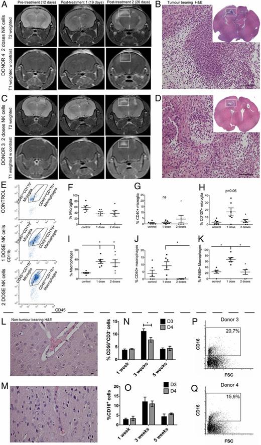 FIGURE 4. Increased proinflammatory macrophages/microglia within the tumor after one-dose NK cell treatment. (A) Longitudinal T2-weighted (upper panels) and postcontrast T1-weighted (lower panels) images of NOD/SCID mice bearing P3 tumors before (12 d) and after treatment with one or two doses (19 and 26 d, respectively) of NK cells from donor 4. (B) H&E staining of tumor-bearing mouse brain after two doses of donor 3 NK cells. Immune infiltrates in the contralateral hemisphere region as indicated by the white box in (A) (scale bar, 100 μm; original magnification ×200). Inset shows a whole-brain histological section stained with H&E from the white box region on MR images from a representative animal treated with donor 4–derived NK cells. (C) Longitudinal T2-weighted (upper panels) and postcontrast T1-weighted (lower panels) images of NOD/SCID mice bearing P3 tumors before (12 d) and after treatment with one or two doses (19 and 26 d, respectively) of NK cells from donor 3. (D) H&E staining of tumor-bearing mouse brain after two doses of donor 4 NK cells. Immune infiltrates in the contralateral hemisphere region as indicated by the white box in (C) (scale bar, 100 μm; original magnification ×200). Inset shows a whole-brain histological section stained with H&E from the white box region on MR images from a representative animal treated with donor 3–derived NK cells. (E) Representative examples of flow cytometry gating of microglia (CD45lowCD11b+) and macrophage (CD45highCD11b+) populations of the control group (top panel) and the groups that received one dose (middle panel) or two doses (bottom panel) of NK cells. (F) Proportions of microglia within all immune (CD45+) cells as evaluated by flow cytometry. Data are mean ± SEM (n = 6/group). Proportions of microglia expressing CD40 (G) or CD127 (H), as evaluated by flow cytometry. Data are mean ± SEM (n = 6/group). (I) Proportions of macrophages within all immune (CD45+) cells, as evaluated by flow cytometry. Data are mean ± SEM (n = 6/group). Proportions of macrophages expressing CD40 (J) or F4/80 (K), as evaluated by flow cytometry. Data are mean ± SEM (n = 6/group). Histological H&E staining of nontumor-bearing mouse brain after two doses of donor 4 NK cells (L) or two doses of donor 3 NK cells (M) (scale bar, 10 μm; original magnification ×400). Percentage of donor 3 and donor 4 NK cells (CD56+ and CD3−) (N) and CD16+ NK cells (O) in nontumor–bearing mouse brains 1, 3, and 5 wk after NK cell treatment. Dot plots of CD16 versus FSC showing the percentage of CD16+ cells present 3 wk after donor 3 (P) or donor 4 (Q) NK cell treatment. *p < 0.05.