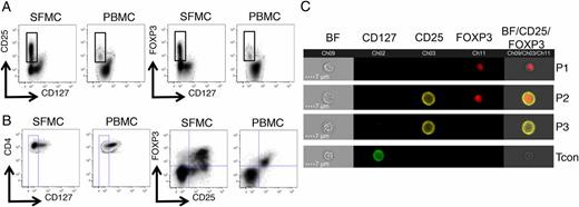 FIGURE 1. Dissociation of CD25 and FOXP3 expression at the inflamed site. Flow cytometry data, gated on CD3+CD4+ T cells, of paired SFMC and PBMC samples from a JIA patient displaying (A) CD25 versus CD127 expression (left) and FOXP3 versus CD127 expression (right). Because FOXP3hi and CD25hi cells are almost uniformly CD127lo, a CD4+CD127lo gate (B, left) was set to analyze the relationship between FOXP3 and CD25 expression (B, right). (C) Multispectral imaging flow cytometry was performed on CD4+ T cells from SFMCs of a JIA patient. Four representative image panels are displayed illustrating the four populations identifiable by the imaging of CD25 and FOXP3 staining. Brightfield (BF), CD25, and FOXP3 images were merged, with BF intensity set to 40% and CD25 and FOXP3 at 100%.