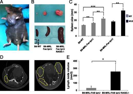 FIGURE 1. RAGE deficiency enhances lymphoproliferation in B6-MRL-Fas lpr/J mice. (A) Representative B6-MRL-Fas lpr/J RAGE−/− mouse aged 7 mo with massive cervical lymphadenopathy. (B) Representative lymph nodes and spleens from B6-WT, B6-MRL-Fas lpr/J, and B6-MRL-Fas lpr/J RAGE−/− mice (scale bar, 10 mm). (C) Spleen size of B6-WT (n = 11), B6-MRL-Fas lpr/J (n = 13), and B6-MRL-Fas lpr/J RAGE−/− (n = 14) mice (matched for age and sex). (D) Thoracic micro-computed tomography analysis of B6-MRL-Fas lpr/J (left) and B6-MRL-Fas lpr/J RAGE−/− mice (right) showing increased volume and number of nodes in RAGE-null animals. Axillary lymph nodes are circled in yellow. (E) Measurement and quantification of lymph nodes volume after three-dimensional reconstruction, using Amira software: B6-MRL-Fas lpr/J (n = 4) and B6-MRL-Fas lpr/J RAGE−/− (n = 5). Data shown are mean ± SEM. Statistical significance was assessed using the Mann–Whitney U test, *p < 0.05, ** p < 0.005, ***p < 0.0005.