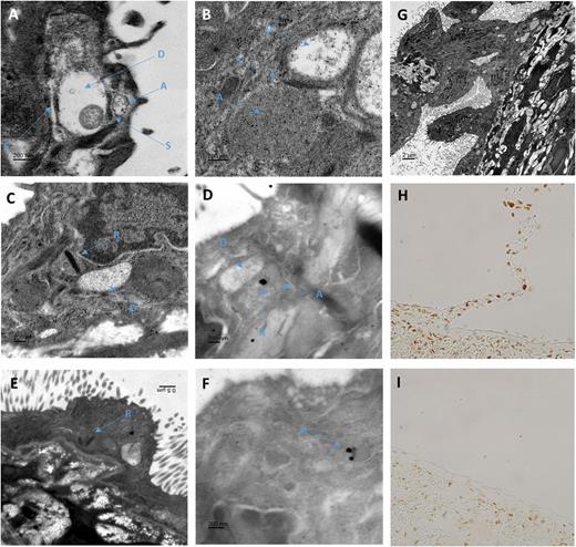 FIGURE 9. Neuronal-like structures identified within mesothelial cells connecting to the splenic capsule. (A and B) Osmium-stained electron micrographs of mesothelial cells on the inferior edge of a Sprague Dawley rat splenic capsule located close to the branch point of a connection. Mesothelial cells were identified by their location above the collagen layer of the splenic capsule and their numerous microvilli. Structures within the mesothelial cell cytoplasm resemble similar structures fond in neuronal tissue. In these images, electron-dense structures similar to that of synaptic junctions (S) can be observed between two circular structures. In (A), one of these low-density circular structures contains a single mitochondrion. These structures are similar to that observed in dendrites (D) of neuronal cells. More densely filled structures run adjacent to the dendritic structure separated by (S), which resemble axons (A) in their arrangement with the dendritic structures and greater electron density. No clear vesicular structures were observed within (A). (C and E) Many of the “axonal-looking” structures (A) were found to contain a dense elongated core, similar to synaptic ribbons (R) observed in the axons of rapidly firing neural cells. (D and F) Shown are urethane-stained sections, which provide less ultrastructural contrast but allow Ag-specific staining. Immunogold labeling of Abs against ribeye, a core component of synaptic ribbons, demonstrated gold particle deposition on the dark-banded structures within mesothelial cells that resembled synaptic ribbons (R). (G) In this low-magnification osmium-stained section, a tissue connection with the splenic capsule can be observed. Mesothelial cells, identified by their microvilli, can be seen lining the entire length of the connection before making contact with other mesothelial cells on the splenic surface. At higher magnification, >15 object pairs, similar to that observed in (C and D), containing all of axon- (A), ribbon- (R), and dendritic- (D) like structures can be seen in this image. (H and I) Paraffin-embedded sections of rat spleen stained with anti-ribeye, a core component of synaptic ribbons. As shown in (H), mesothelial cells located on structures that connect to the splenic capsule as well as mesothelial cells immediately adjacent to these junctions stain positive for ribeye. As demonstrated in (I), mesothelial cells in areas where these junctions are not present are negative for ribeye, whereas the splenic parenchyma is positive.