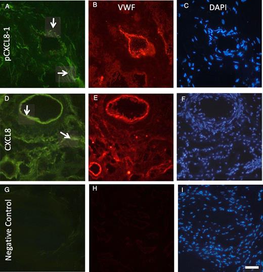 FIGURE 5. pCXCL8-1 and CXCL8s interact with ECs in human RA synovium. Representative immunofluorescence images of human RA synovium. The von Willebrand factor staining is in red, highlighting ECs, and green represents either pCXCL8-1 or CXCL8 positive staining. (A) pCXCL8-1 binding, (B) von Willebrand factor, (C) DAPI. (D) CXCL8 binding, (E) Von Willebrand factor, (F) DAPI. (G) Negative control with no pCXCL8-1 or CXCL8, (H) no Von Willebrand factor, (I) DAPI. Arrows indicate positive pCXCL8-1 or CXCL8 staining of blood vessels and in the extracellular matrix. Scale bar, 50 μm for each image.