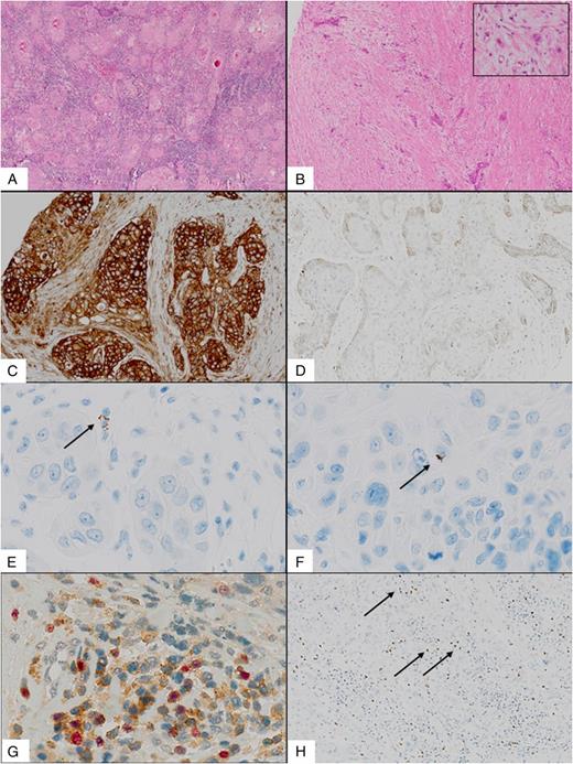 FIGURE 1. (A and B) Representative H&E-stained OSCC, (A) showing an OSCC with high-density lymphocytic infiltration, and (B) showing an OSCC with a low-density lymphocytic infiltration. Insert, Presence of TBA with single-cell infiltration. (C and D) Representative HLA class I–stained OSCC, (C) showing strong membranous HLA class I expression in >95% of TCs, and (D) showing weak membranous HLA class I expression in 10% of TCs. (E and F) Representative IFN-γ mRNA–ISH in OSCC, (E) showing IFN-γ mRNA expression in TILs and (F) showing IFN-γ mRNA expression in TCs. (G and H) Representative OSCC with FOXP3+ TILs, (G) showing double staining against FOXP3 and CD4 with coexpression of CD4 and FOXP3 in FOXP3+ TILs, proving FOXP3+CD4+ cells to be Tregs (red: FOXP3; brown: CD4). (H) High-density stromal FOXP3+ TILs. Arrows indicate positive staining results for respective stainings; staining performed one time. n = 66 patient cases/staining included. Original magnification ×2 (A), ×4 (B), ×10 [(B) inset, (C, D, H)], ×40 (E–G).
