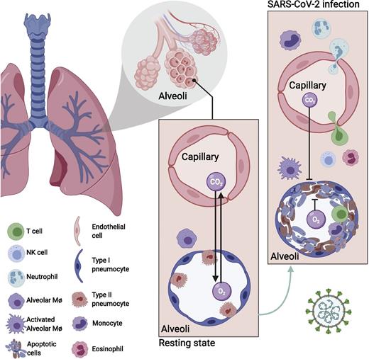 FIGURE 3. Immune pathology in SARS-CoV-2–infected lung tissue. The lung, the critical organ for gas exchange, is the target of SARS-CoV-2 infection. In healthy tissue, the alveolae at the ends of terminal bronchi are critical for the flow of oxygen, and few immune cells, such as alveolar macrophages, are located in the tissue but in a resting state. The proximity of capillaries to the alveoli allows the exchange of O2 and CO2 to replenish the O2 supply in the blood. After SARS-COV-2 infection, inflammation is induced in the tissue, involving cellular recruitment of many types of immune cells, including T cells, NK cells, neutrophils, inflammatory monocytes, and potentially others (28, 49). These immune cells have an activated phenotype and can even be found in the BAL (49). Tissue damage results in a hyaloid membrane, a layer of dead and dying cells in the alveoli that may limit gas exchange (48).
